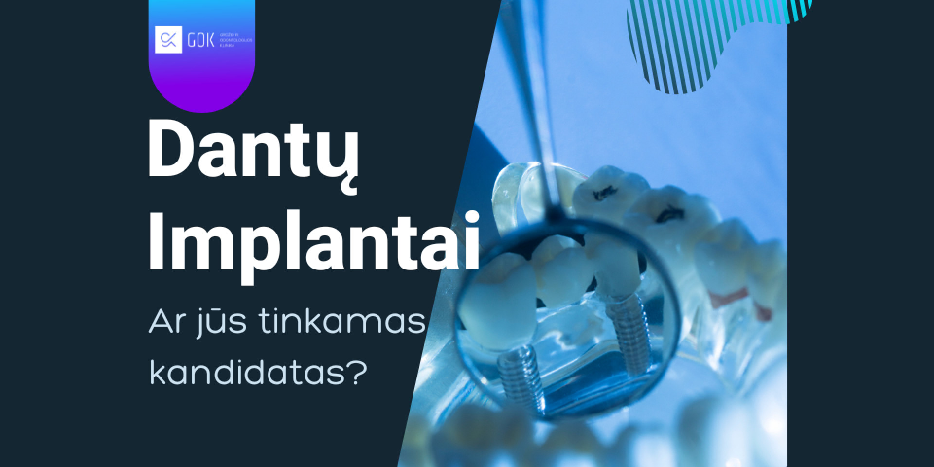 Dantų implantacija - kelias į tobulą šypseną: ar esate tinkamas kandidatas?