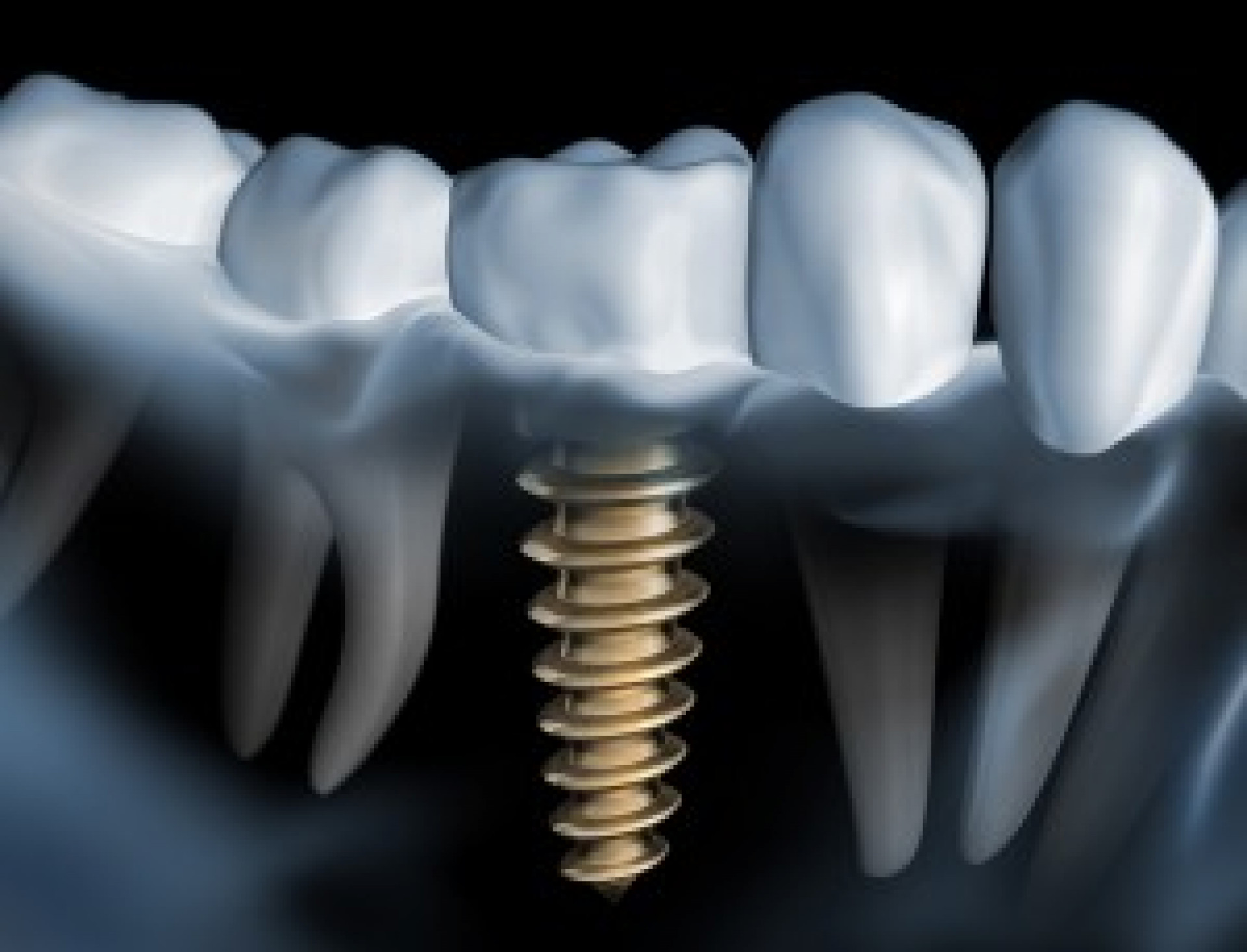 Kaip atliekama dantų implantacija?