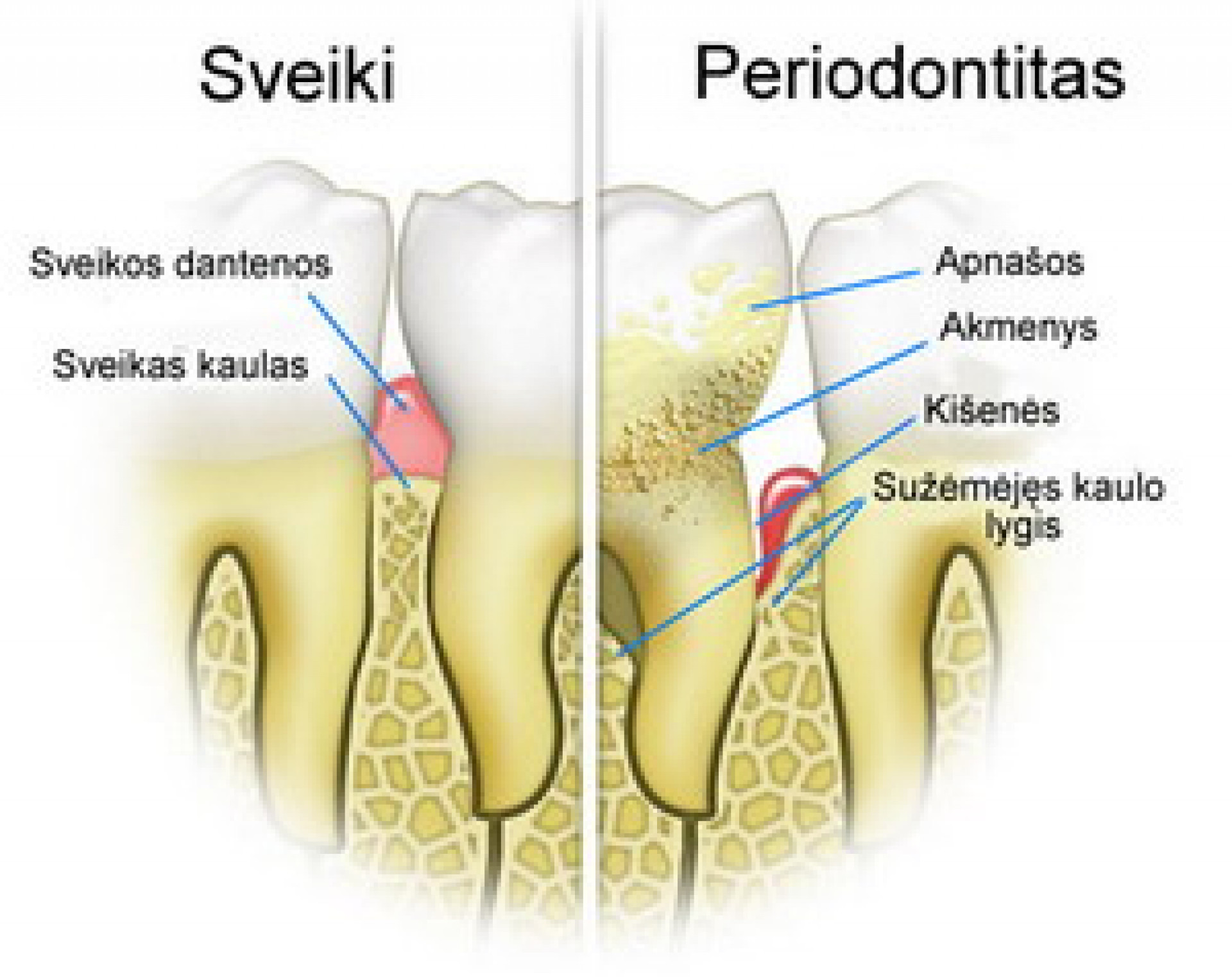 Periodontitas – liga, dėl kurios netenkami dantys
