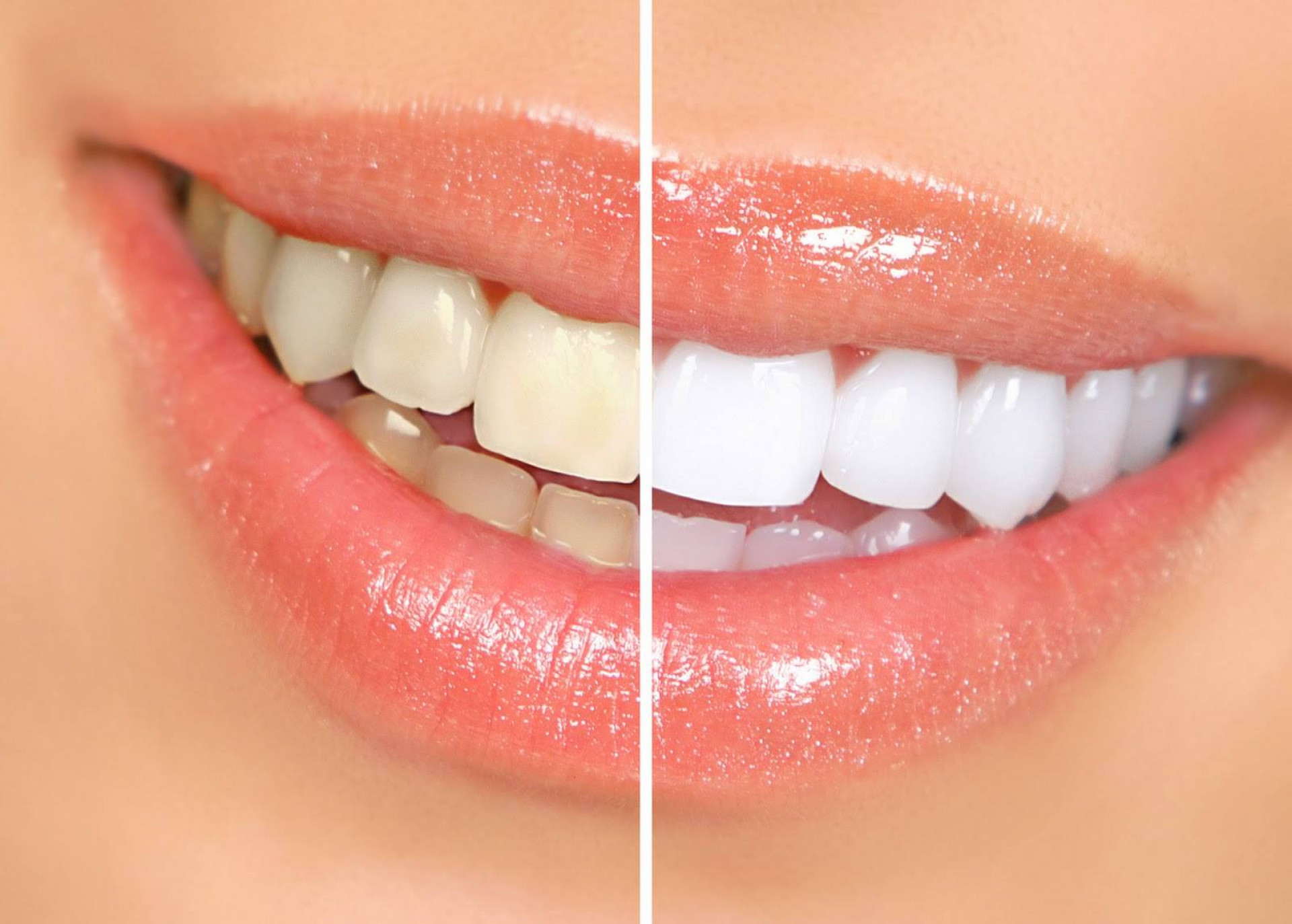 Norite baltesnių dantų? Ką reikia žinoti?