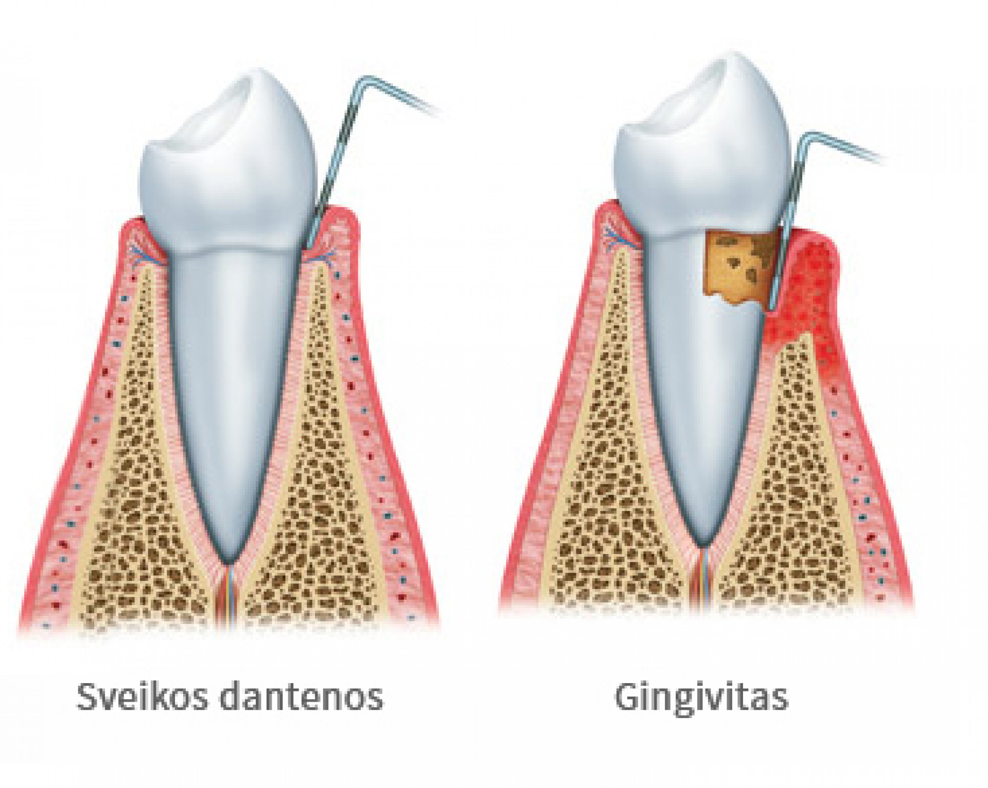 Gingivitas – dantenų uždegimas